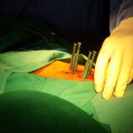 Minimally-Invasive-Spine-Surgery
