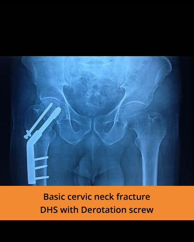 Basic-cervic-neck-fracture-(Ortho-hospital).JPG