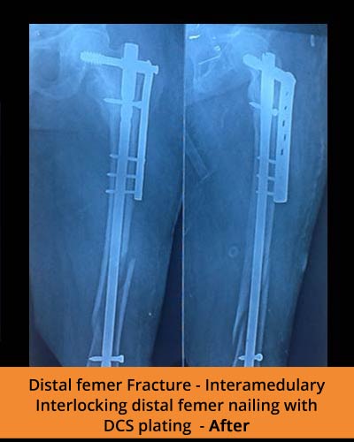 Distal-Femer-Fracture-(Ortho-hospital).jpg