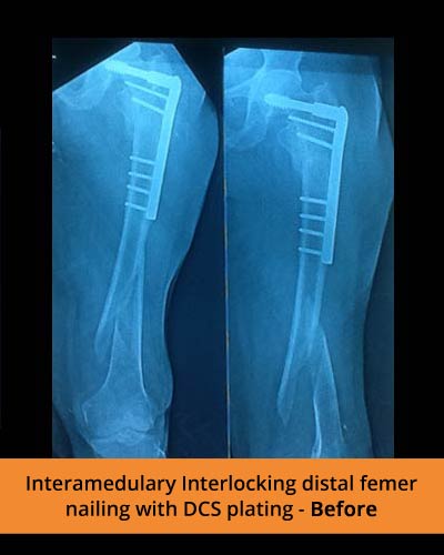 Interamedulary-Interlocking-distal-femer-nailing-with-DCS-plating-Before-(Ortho-hospital).jpg