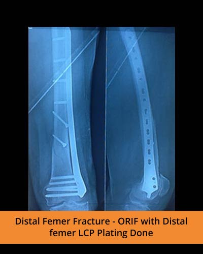 ORIF-with-Distal-femer-LCP-Plating-Done-(Ortho-hospital).jpg