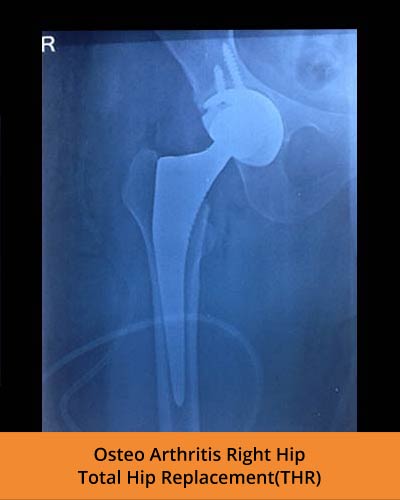 Osteo-Arthritis-Total-Hip-Replacement(THR)-(Ortho-hospital).jpg