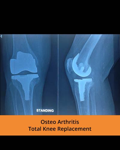 Osteo-Arthritis-Total-Knee-Replacement-(Ortho-hospital).jpg