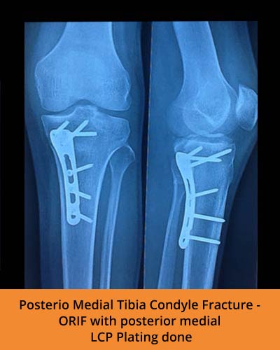 Posterio-Medial-Tibia-Condyle-Fracture-(Ortho-hospital).jpg
