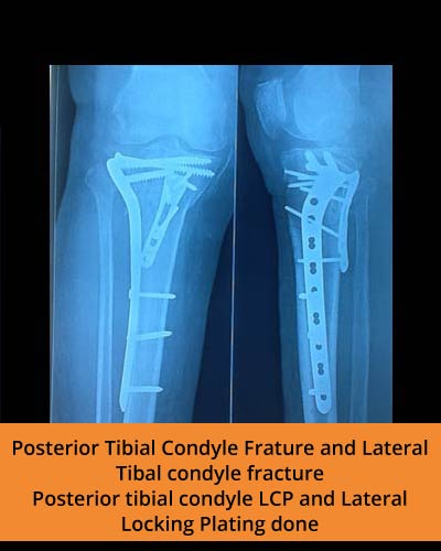 Posterior-Tibial-Condyle-Frature-and-Lateral-Tibal-condyle-fracture-(Ortho-hospital).jpg