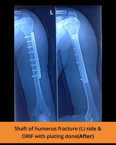 Shaft-of-humerus-fracture-(Ortho-hospital).JPG