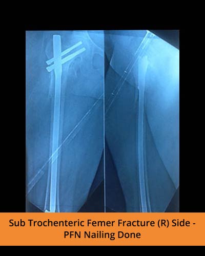 Sub-Trochenteric-Femer-Fracture-(Ortho-hospital).jpg