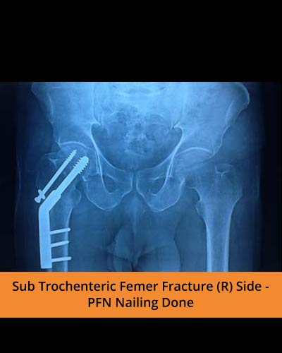 Sub-Trochenteric-Femer-Fracture-PFN-(Ortho-hospital).jpg