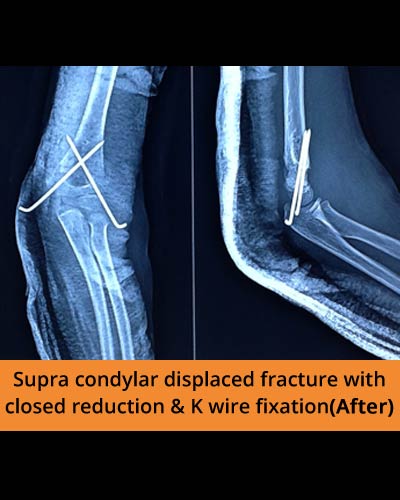 Supra-condylar-displaced-fracture-(Ortho-hospital).JPG