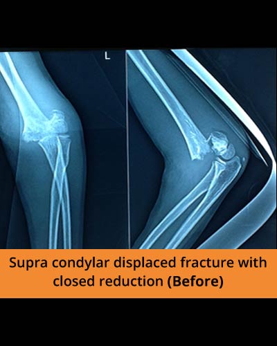 Supra-condylar-displaced-fracture-K-wire-fixation-(Ortho-hospital).JPG