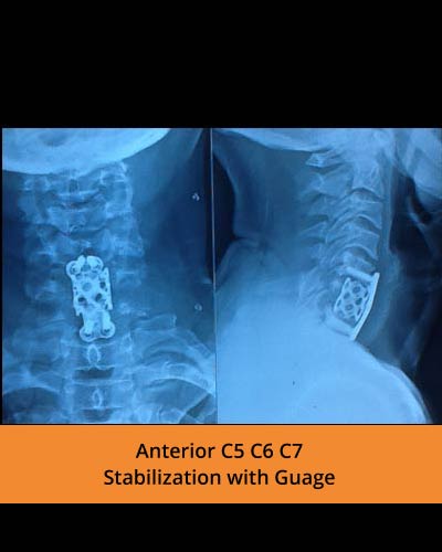 Anterior-C5-C6-C7-Stabilization-with-Guage(Spine-Hospitals).jpg