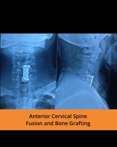Anterior-Cervical-Spine-Fusion-and-Bone-Grafting(TPN-Hospitals).jpg