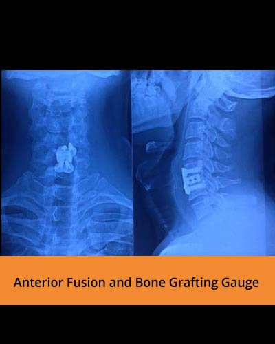 Anterior-Fusion-and-Bone-Grafting-Gauge(TPN-Spine-Hospitals).jpg