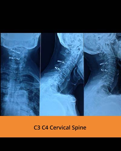 C3-C4-Cervical-Spine(TPN-Hospitals-spine).jpg