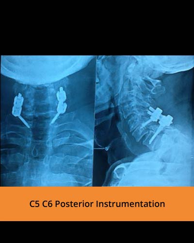 C5-C6-Posterior-Instrumentation(TPN-Hospitals).jpg
