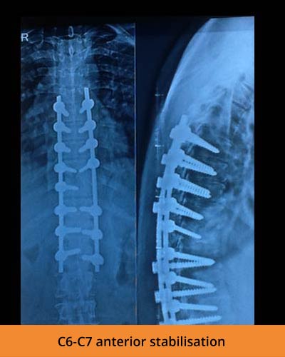 C6-C7-anterior-stabilisation(TPN-Hospitals-Spine).jpg