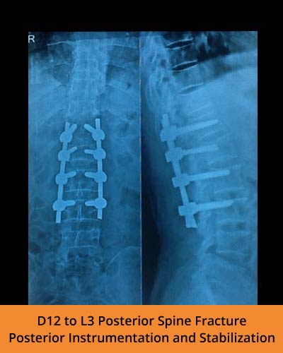 D12-to-L3-Posterior-Spine-Fracture-Posterior-Instrumentation-and-Stabilization(TPN-Hospitals-spine).jpg