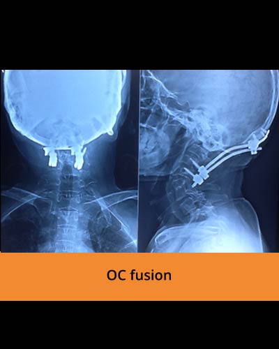 OC-fusion-spine-treatment-(TPN-Hospitals).jpg