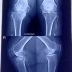 Proximal fibula Osteotomy