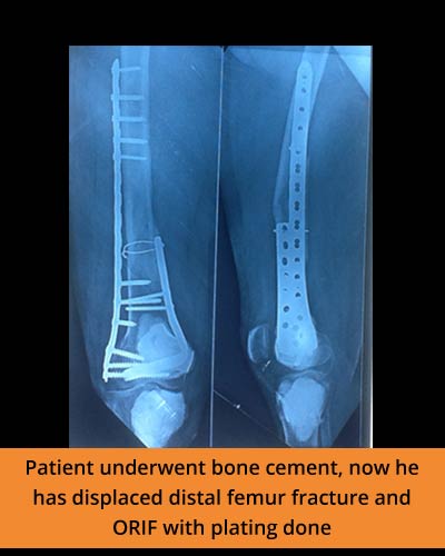 distal-femur-fracture-and-ORIF-with-plating-done-(Ortho-hospital).JPG