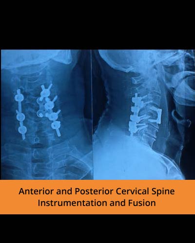 Anterior-and-Posterior-Cervical-Spine---Instrumentation-and-Fusion(Spine-Hospitals).jpg