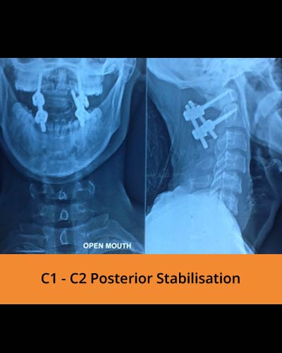 C1-C2-Posterior-Stabilisation(Spine-surgeon).jpg