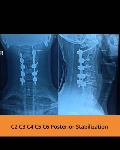 C2-C3-C4-C5-C6-Posterior-Stabilization(Spine-Hospitals).jpg