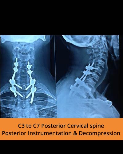 C3-to-C7-Posterior-Cervical-spine-Posterior-Instrumentation-&-Decompression(TPN-Hospitals).jpg