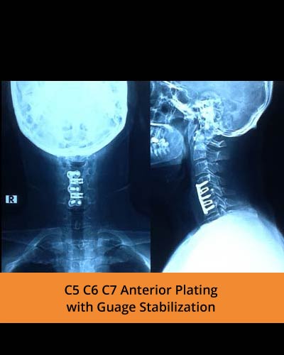 C5-C6-C7-Anterior-Plating-with-Guage-Stabilization(TPN-Hospitals-spine).jpg