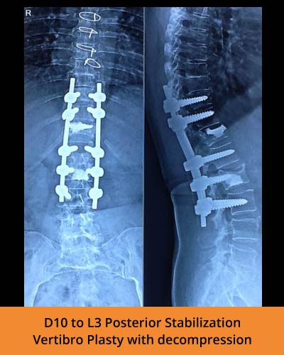 D10-to-L3-Posterior-Stabilization-Vertibro-Plasty-with-decompression(TPN-Hospitals-Spine).jpg
