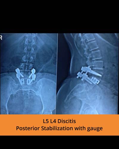L5-L4-Discitis-Posterior-Stabilization-with-gauge(Spine-Surgeon).jpg