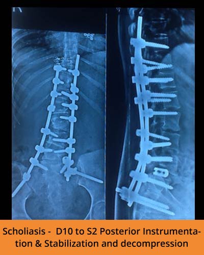 Scholiasis-D10-to-S2-Posterior-Instrumentation-&-Stabilization-and-decompression(Spine-Hospitals).jpg